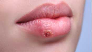 Lip of woman with a cold sore