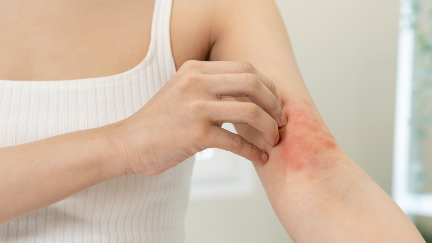 Young woman with eczema scratching her skin on the inner side of her elbow