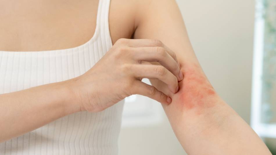 Supplements for Eczema - ConsumerLab.com Supplements for Eczema - ConsumerLab.com